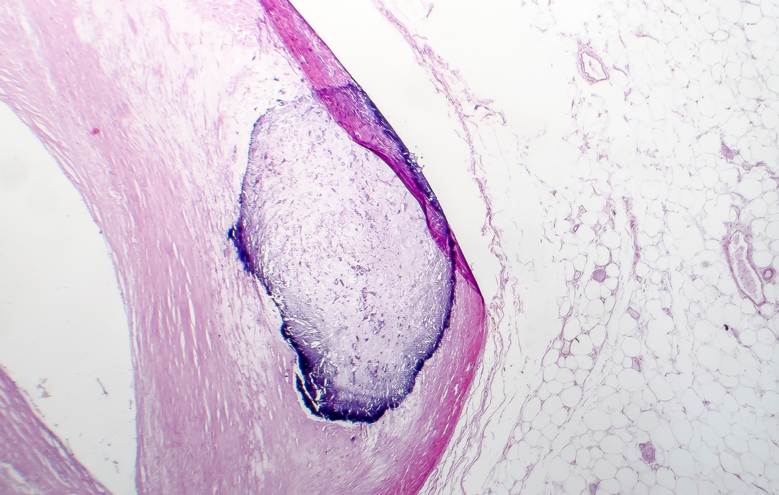 coronary artery calcification ai