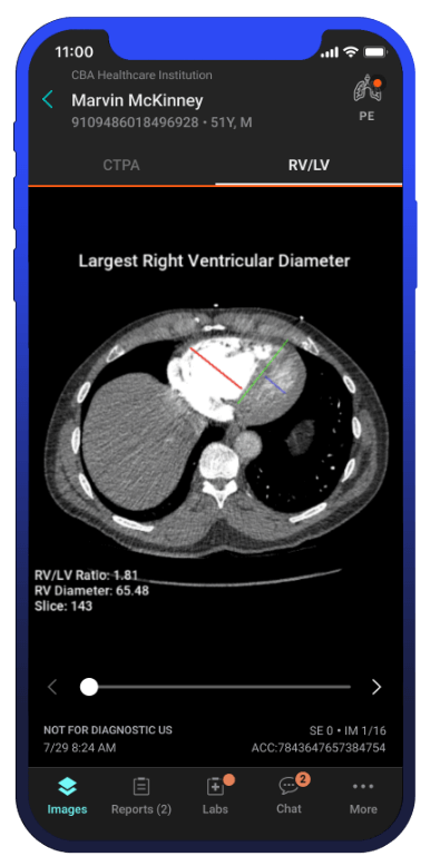 Aidoc VTE Solutions RV-LV Ratio-BasedRisk Stratification on an iPhone