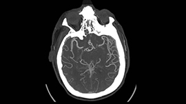 Brain Aneurism scan