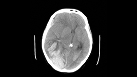 Intracranial Hemmorhage scan