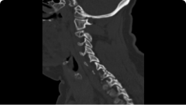 Acute C Spine Fracture scan