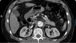 Aortic Dissection scan