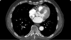 Radiology Incidental PE scan