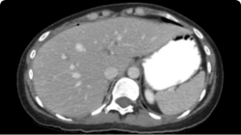 Intra-abdominal free gas scan