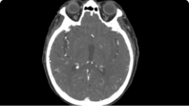 large vessel occlusion scan