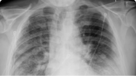 Radiology Pneumothorax scan