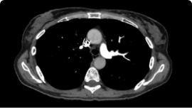 Pulmonary embolism scan