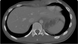 Rib Fracture scan