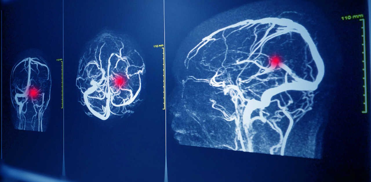 Detecting brain aneurysm with AI