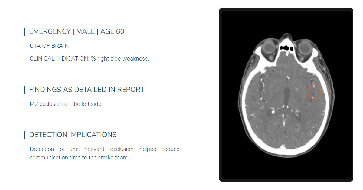 Stroke AI case example: Brain CTA of a 60-year-old male with right-side weakness showing an M2 occlusion on the left side. Stroke AI detection reduced communication time to the stroke team, facilitating faster treatment.